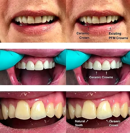 Before and after comparison showing ceramic crown replacement results at The Hamptons Dentist in Westhampton Beach NY