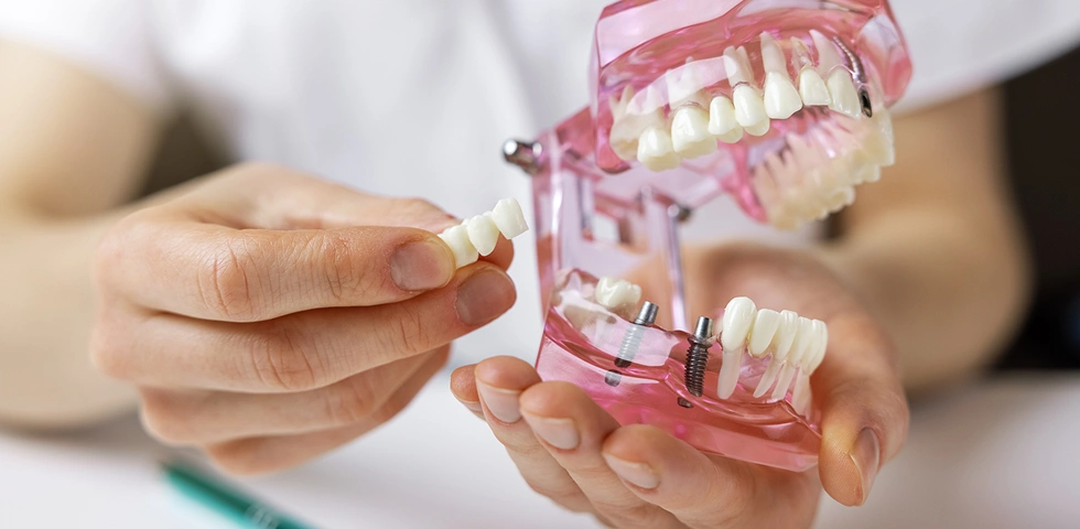 Dental implant model with a pink jaw showing the implant post and crown placement