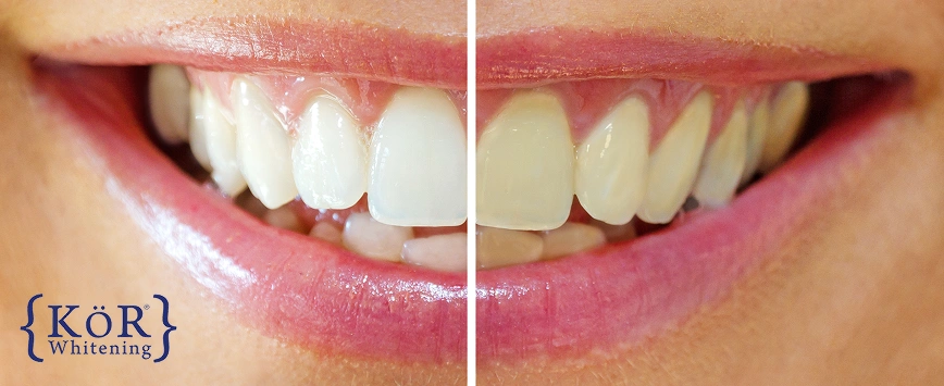 Before and after teeth whitening results showing brighter whiter teeth