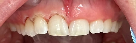 Before photo showing uneven gum line prior to laser gum surgery at The Hamptons Dentist