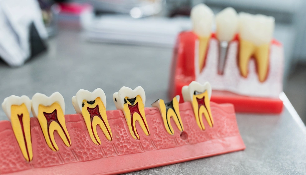 Comfortable root canal procedure at The Hamptons Dentist