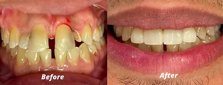 Before and after smile transformation showing improved teeth color and alignment at The Hamptons Dentist