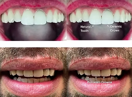 Before and after comparison showing natural tooth replaced with a ceramic crown at The Hamptons Dentist in Westhampton Beach NY
