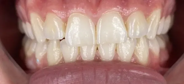 Before Veneers