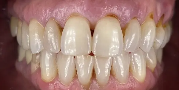 Before Veneers
