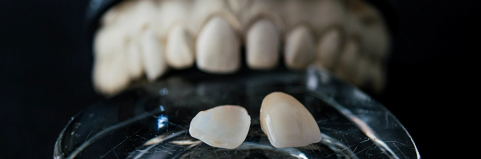 Close up of beautiful white porcelain veneers