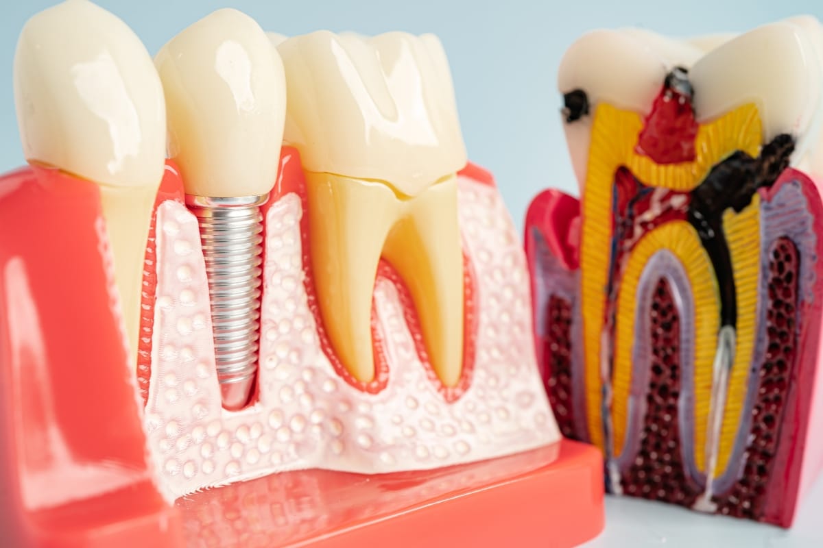 Screwless Dental Implants