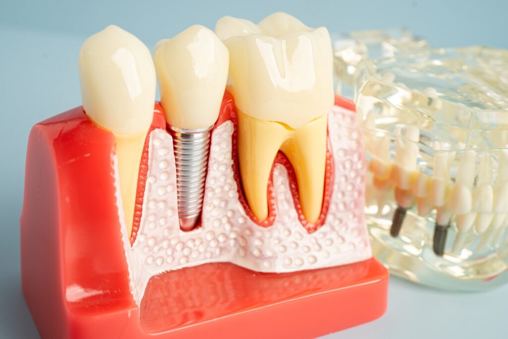 missing teeth replacement
