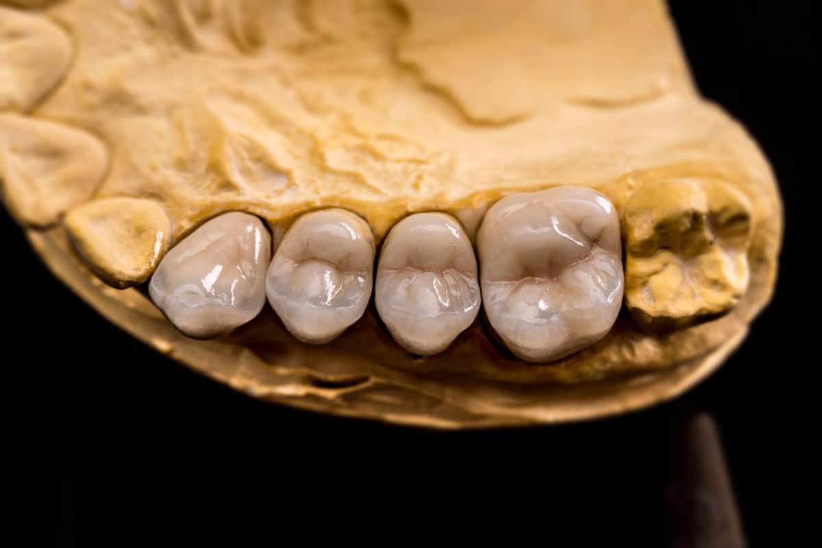 Same Day Crowns vs. Traditional Crowns