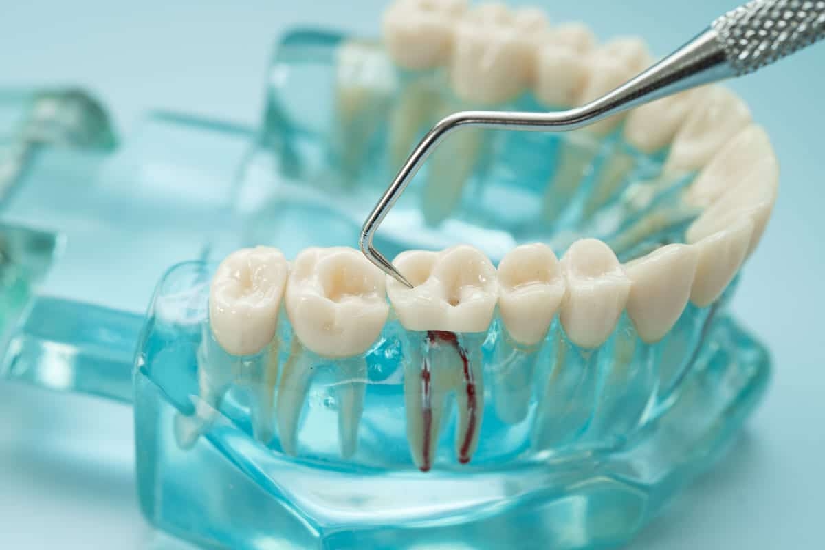 Root Canal Treatment in Westhampton Beach