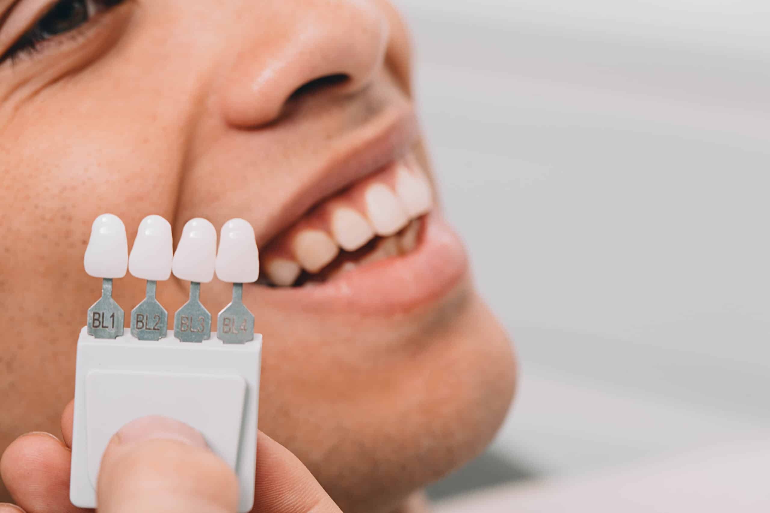 Dental veneer shade guide showing four tooth-colored porcelain veneers with labeling for natural tooth matching.